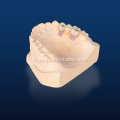 3D na naka -print na modelo ng pagpapanumbalik ng implant
